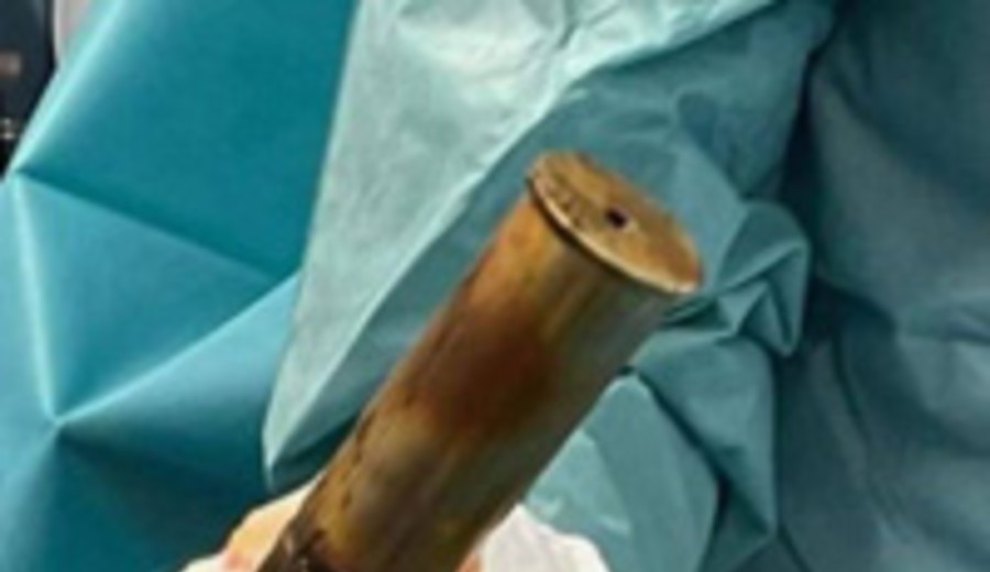 imagen de Evacúan hospital en Francia por hombre con bomba de Primera Guerra Mundial en su ano