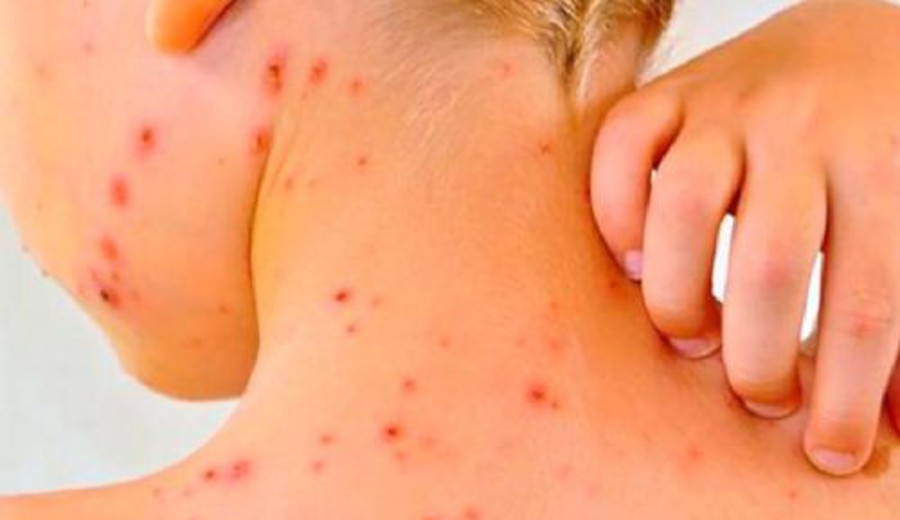 imagen de Caso autóctono de sarampión en San Javier intensifica vacunación y mantiene centros de enseñanza cerrados