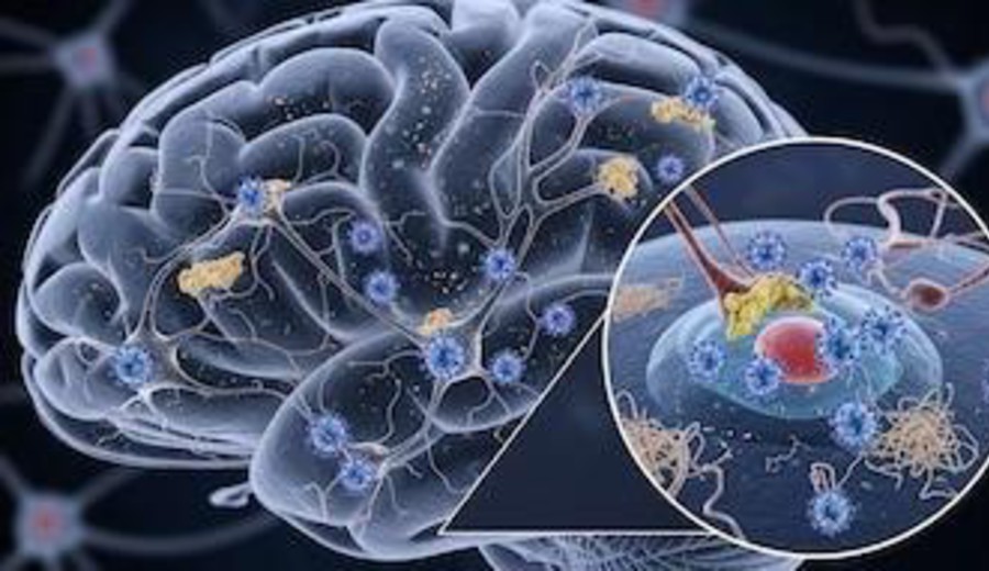 imagen de La infección por el virus del herpes podría acelerar el desarrollo del Alzheimer, según un estudio en ratones
